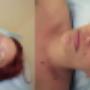 Cavi lipo . ansikts behandling 30 min